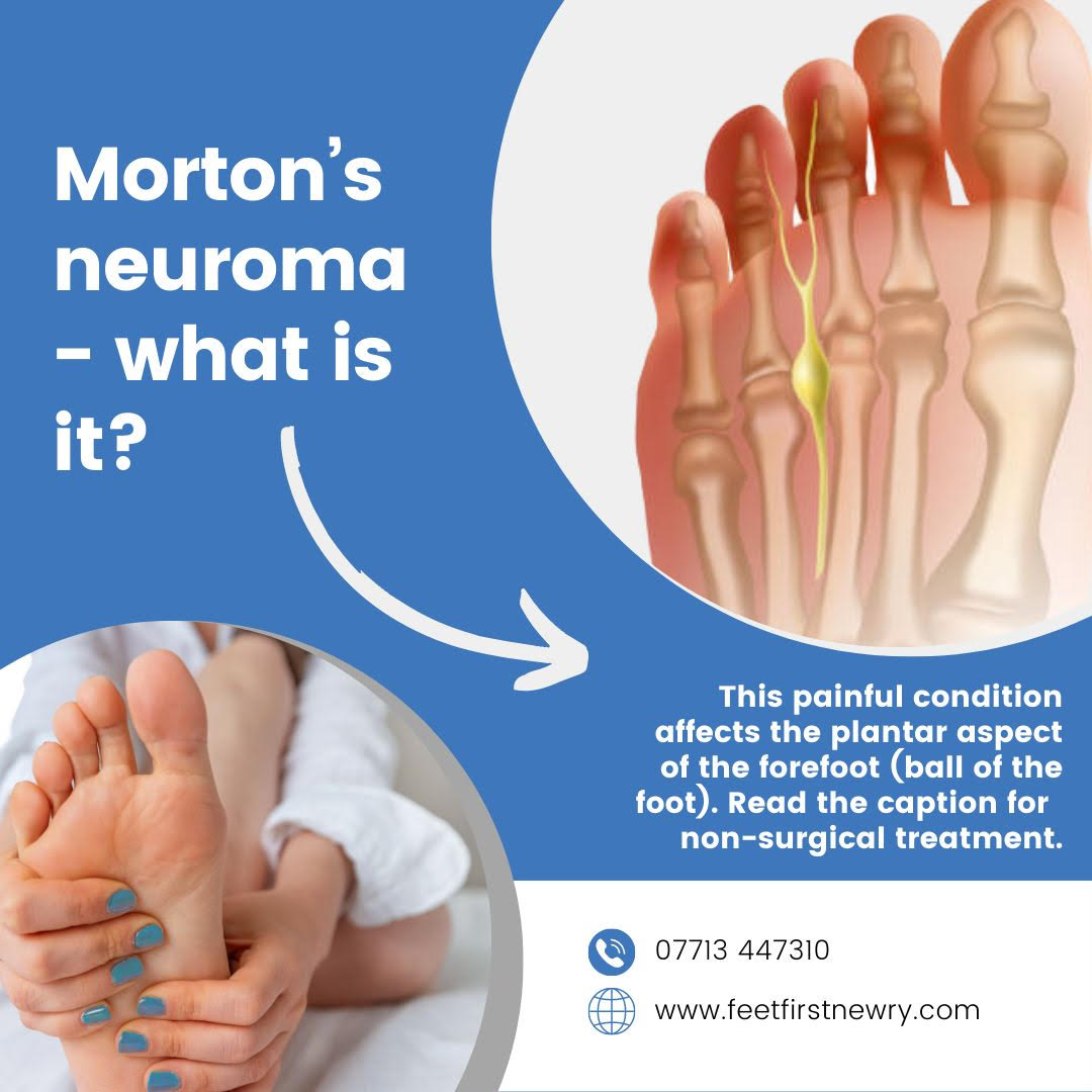 Feet First Newry, Foot Clinic - Morton’s neuroma